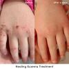 imageEvereden Healing Eczema Treatment 17 fl oz  Eczema Cream  Clean and Fragrance Free Cream for Babies Kids and Adults  FSA EligibleCream