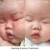 imageEvereden Healing Eczema Treatment 17 fl oz  Eczema Cream  Clean and Fragrance Free Cream for Babies Kids and Adults  FSA EligibleCream